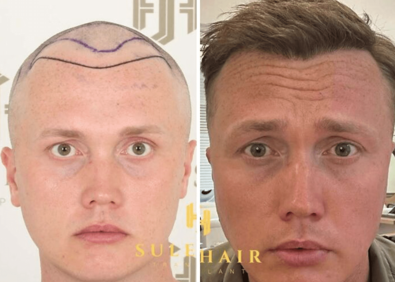 Wie eine Haartransplantation das Aussehen verändert: Vorher-Nachher-Bilder und Expertenmeinungen ➤ Globenow.info