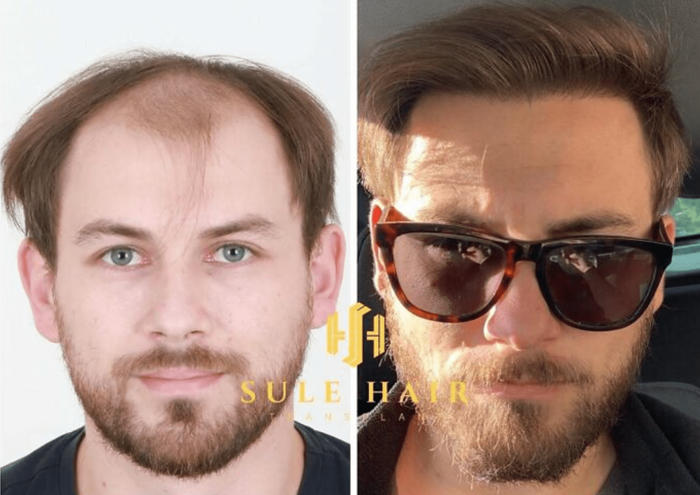 Wie eine Haartransplantation das Aussehen verändert: Vorher-Nachher-Bilder und Expertenmeinungen